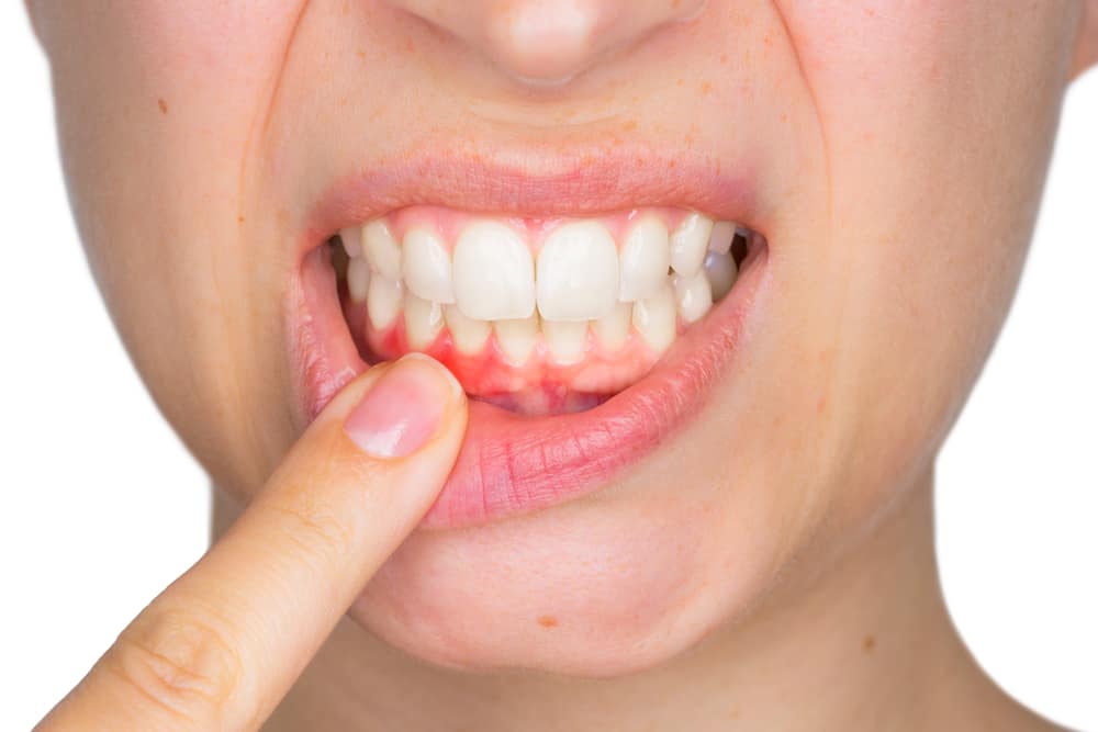 Understanding Gum Disease (Periodontal Disease)